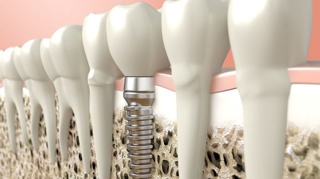 Dental Implants Santa Clarita
